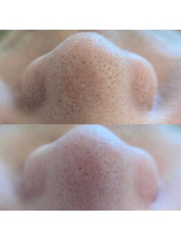 アネモネ(ANEMONE)/韓国式3D毛穴洗浄