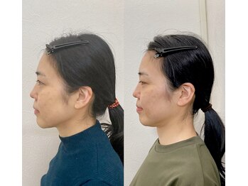 小顔22 ボルティ 赤坂支店(Bolty)/【悩み】30代：角ばった顔の輪郭