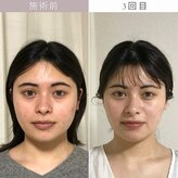 マルヒア