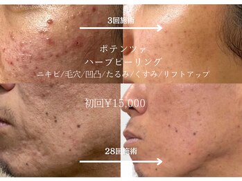 エイミー(Aimee)/長年お悩みだったニキビに