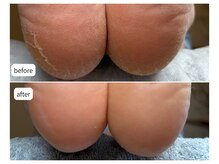 カシェット(Cachette)/40代女性◎足裏角質ケア90分