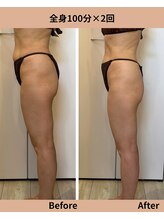 タノソイネ(tanosoine)/【痩身/ハイパーナイフ痩身】