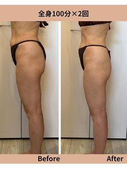 タノソイネ(tanosoine)/【痩身/ハイパーナイフ痩身】