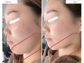 エミレ(emire)の写真/【たるみ・二重あご・顔まわりの脂肪を撃退】話題の脂肪分解美容液をプラズマで導入！溶かして流して排出★