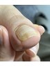 【巻き爪1本ケア】北海道では珍しい自然治癒力を利用した施術 ｜45分¥11000→