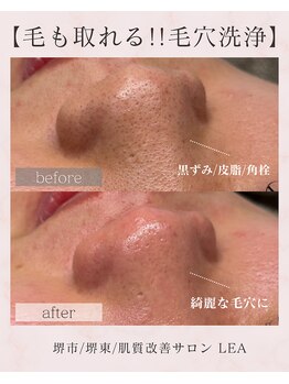 レア(Lea)/1回目から効果抜群＊