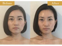 モモスパ(MOMOspa.)/頭蓋骨小顔矯正ビフォアフター