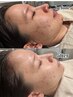 【プラズマシャワー】韓国美容外科発！肌質改善マシン