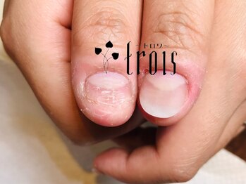 トロワ 中目黒(trois)の写真/《トロワは1日3名様限定の贅沢サロン》♪深爪でお悩みの方へ★【HAND】深爪矯正！長年の悩みを解消◎
