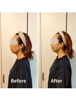 ラヴィフルリル(Ravi FleuRir)/小顔矯正ヘッドスパの変化