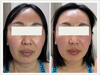 恵比寿脱毛 シーズ(She’s)/ソフトダーマ40代ビフォア