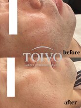 トイヴォ(TOIVO)/顔脱毛ビフォーアフター！