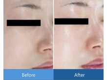 ローズドゥシャロン(Rose de CHALON)/キメも整いなめらかな肌に★