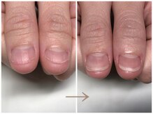 アウェイク ネイル(Awake Nail)/深爪矯正/自爪育成/秋葉原