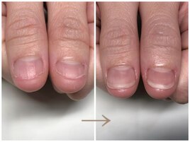 深爪矯正/自爪育成/秋葉原