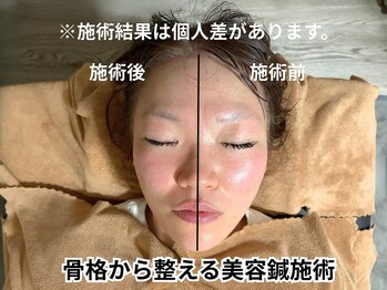 カンワ美容鍼灸院(KANWA美容鍼灸院)の写真/ただ小さくするだけじゃない。あなたの魅力が引き立つフェイスラインへ