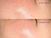 レイル(REIR)/上：施術3回目、下：施術4回目