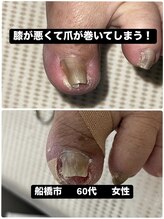 巻き爪じゅん 船橋店/膝の問題による巻き爪の痛み克服