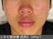 オアシスラグーン(OASIS LAGOON)/ニキビ後の凹凸（症例2施術6回）