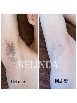 ベリンダ(BELINDA)/光脱毛