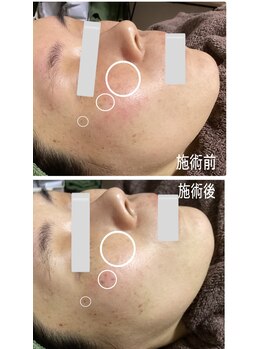 ブライトリー(Brightly)/最新光エステで本気のシミ改善!