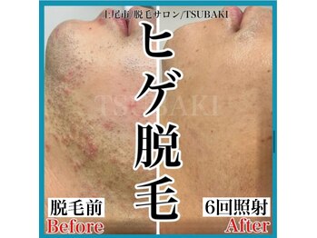 ツバキ(TSUBAKI)/ヒゲ脱毛