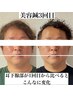 【最強モテ男・再来】メンズ美容鍼 60分￥11,000