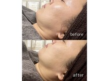 パールフェイスエステ ルペルル(PEARL FACE ESTHE la perle)/タルミ改善