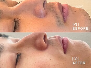 ファン(FAN)/【メンズひげ脱毛】BEFORE-AFTER