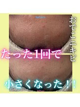 ハニエル(Haniel)/カーボキシービフォーアフター