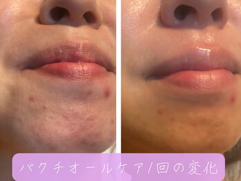 マヨズサロン(Mayo’s salon)/バクチオールケアでの変化