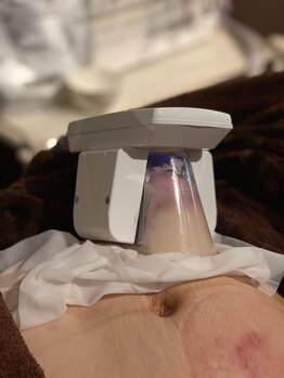 スパフランコルシャン(Spa Francorchamps)/脂肪冷却痩身