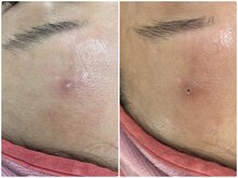 ケーナイン(K nine)/ニキビが！プラズマ照射で