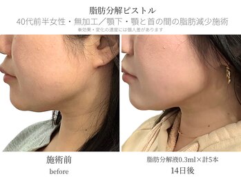 サボラミ(sabor A Mi)/顎下と首間のボリュームも対応◎