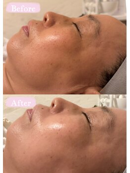 エステサロン アンジュール(Angelle)/Before→After