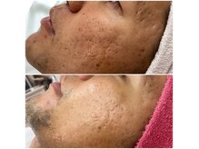 美キュートの雰囲気（男性もご相談ください。ニキビ、凹凸、シミ、脱毛、抜毛、毛薄）
