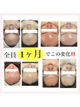 ブレリアントサロン 池袋店(brillant salon)/【劇的変化】年齢肌トータル改善