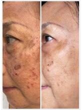 ソルツーサロン マナ(MANA)/最強ハーブピーリング