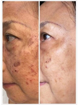 ソルツーサロン マナ(MANA)/最強ハーブピーリング