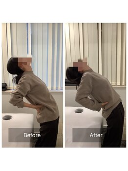 ナオル整体 新宿院(NAORU整体)/30代女性-猫背矯正Before/After