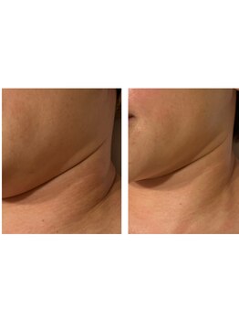 アドビューティ(Add Beauty)/≪たるみ改善／RFリフティング≫