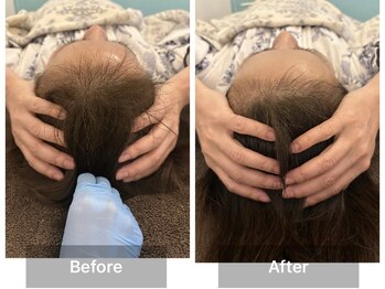 ミルジュ(MiLuJu)/ヘッドスパ/シワ改善ほうれい線