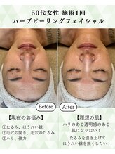 シーフェイス 横浜店(SEE FACE)/剥離&DTなし！ハーブピーリング