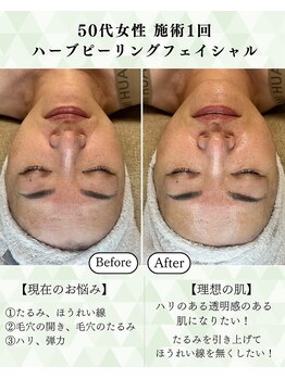 シーフェイス 横浜店(SEE FACE)/剥離&DTなし!ハーブピーリング