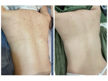 アミュレット(Amulette)/背中ピーリング８回の変化[毛穴]