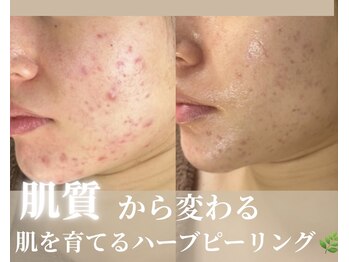 カッカ(kakka)/ニキビケアに◎ハーブピーリング