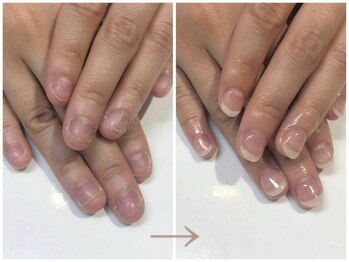 アウェイク ネイル(Awake Nail)/深爪矯正/自爪育成/秋葉原