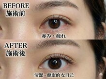 アン(AN)/アイケアホワイトニング