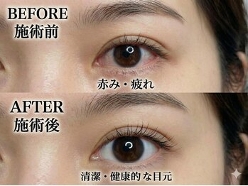 アン(AN)/アイケアホワイトニング