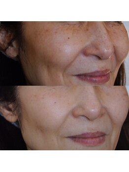 トラット エステアンドアイズ(tratto)/50代お客様症例写真